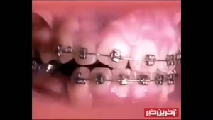 ارتودنسی دندان و عوارض جانبی و مشکلات ناشی در ارتودنسی دندان