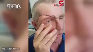 شاهکار پزشکی برای سربازی که نصف صورت خود را از دست داده بود😳😱