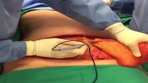 ویدیو جراحی کشیدن پوست