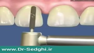 اصلاح دندان با ارتودنسی