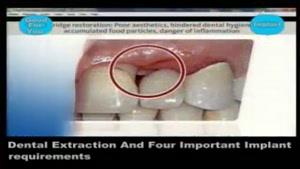 کشیدن دندان ورعایت چهار شرط کاشت دندان