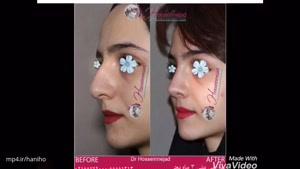 رینوپلاستی قبل و بعد جراحی بینی