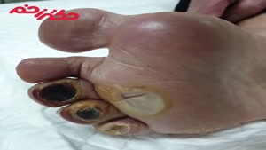 درمان زخم دیابتی انگشتان  و کف پا