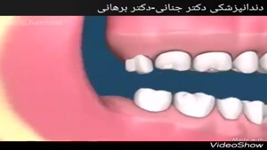 عوارض دندان عقل نهفته