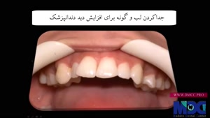 فیلم نصب براکت ارتودنسی|کلینیک دندانپزشکی مدرن