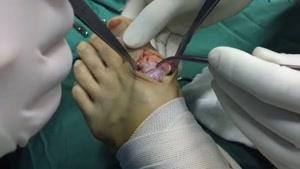 جراحی محدودیت حرکتی انگشت شست پا( هالوکس ریژیدوس)
