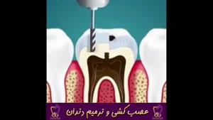 عصب کشی و ترمیم دندان | دکتر ندا هادی جراح و دندانپزشک زیبایی