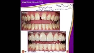 نمونه کارهای لمینت دندان | دکتر ندا هادی جراح و دندانپزشک زیبایی
