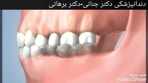 عوارض تحلیل لثه و  از دست رفتن دندان ها