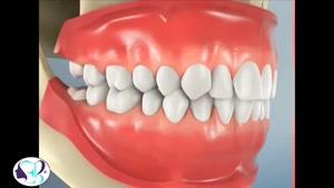 فیلم کامل کشیدن دندان عقل