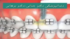 بهداشت دهان و دندان طی درمان های ارتودنسی