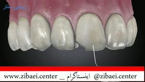 کامپوزیت دندان,پر کردن دندان یا روکش دندان,داندان پزشکی در زیبایی سنتر