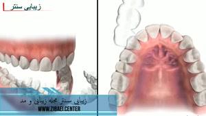 ارتودنسی نامریی دندان,اصلاح فرم دندان در دندانپزشکی,زیبایی سنتر