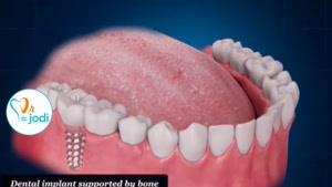 ویدیو جالب در مورد ایمپلنت دندان
