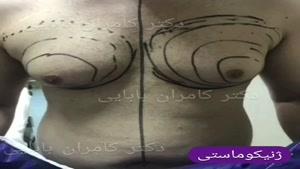 فیلم جراحی کوچک کردن سینه مردان توسط دکتر کامران بابایی