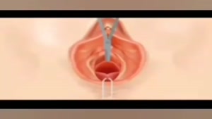 انیمیشن تنگ کردن واژن