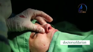 فیلم جراحی زیبایی بینی بلافاصله بعد از اتمام جراحی بینی