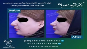 نمونه جراحی های بینی دکتر فرشید صفدریان