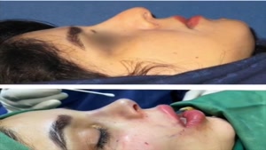 جراحی بینی با تزریق چربی لب گونه و شقیقه