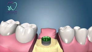 انیمیشن ایمپلنت دندان