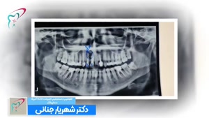 جراحی دندان 2 همراه با پیوند پودر استخوان