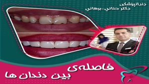 صحبت های دکتر شهریار جنانی در خصوص فاصله ی بین دندان ها
