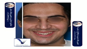 جراحی بینی مردانه با پوست ضخیم و قوز و انحراف شدید