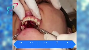 جراحی درآوردن دندان نیش نهفته در کام