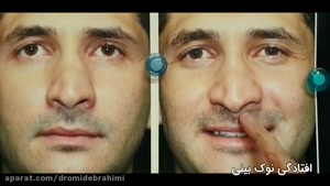 عمل ترمیمی بینی توسط دکتر امید ابراهیمی بهترین جراح بینی ترمیمی در تهران