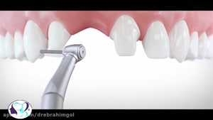 توضیحات دکتر ابراهیم گل درباره ایمپلنت دندان