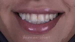 زیبایی طرح لبخند شما با کامپوزیت ونیر در کلینیک بارانا