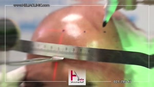 فیلم واقعی حین جراحی کاشت مو میکروگرافت پرتراکم ترین روش پیو