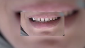 فیلم چگونگی انجام لمینت دندان (مراحل آماده سازی تا نصب)