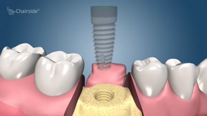 مراحل انجام ایمپلنت دندان چگونه است؟