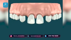 چگونه ارتودنسی به کمک درمان ایمپلنت دندان می آید؟