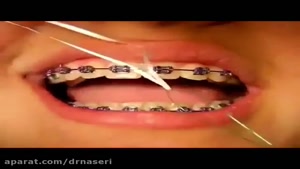 طرز استفاده از نخ دندان ارتودنسی oral b