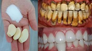 سفید کردن دندان فقط در 1 دقیقه / دندان های سفید شیری و براق