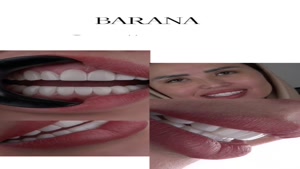 کامپوزیت دندان مشهد در کلینیک بارانا