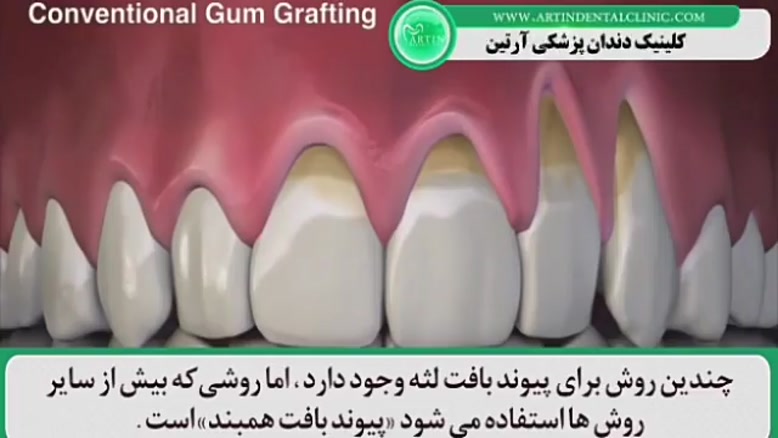 درمان مشکلات لثه و بافت لثه ( دندانپزشکی شبانه روزی آرتین )