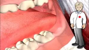 چگونه دندان عقل برداشته می شود